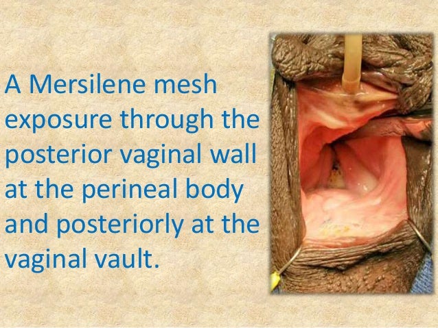 vaginal wall texture Vaginal wall texture
